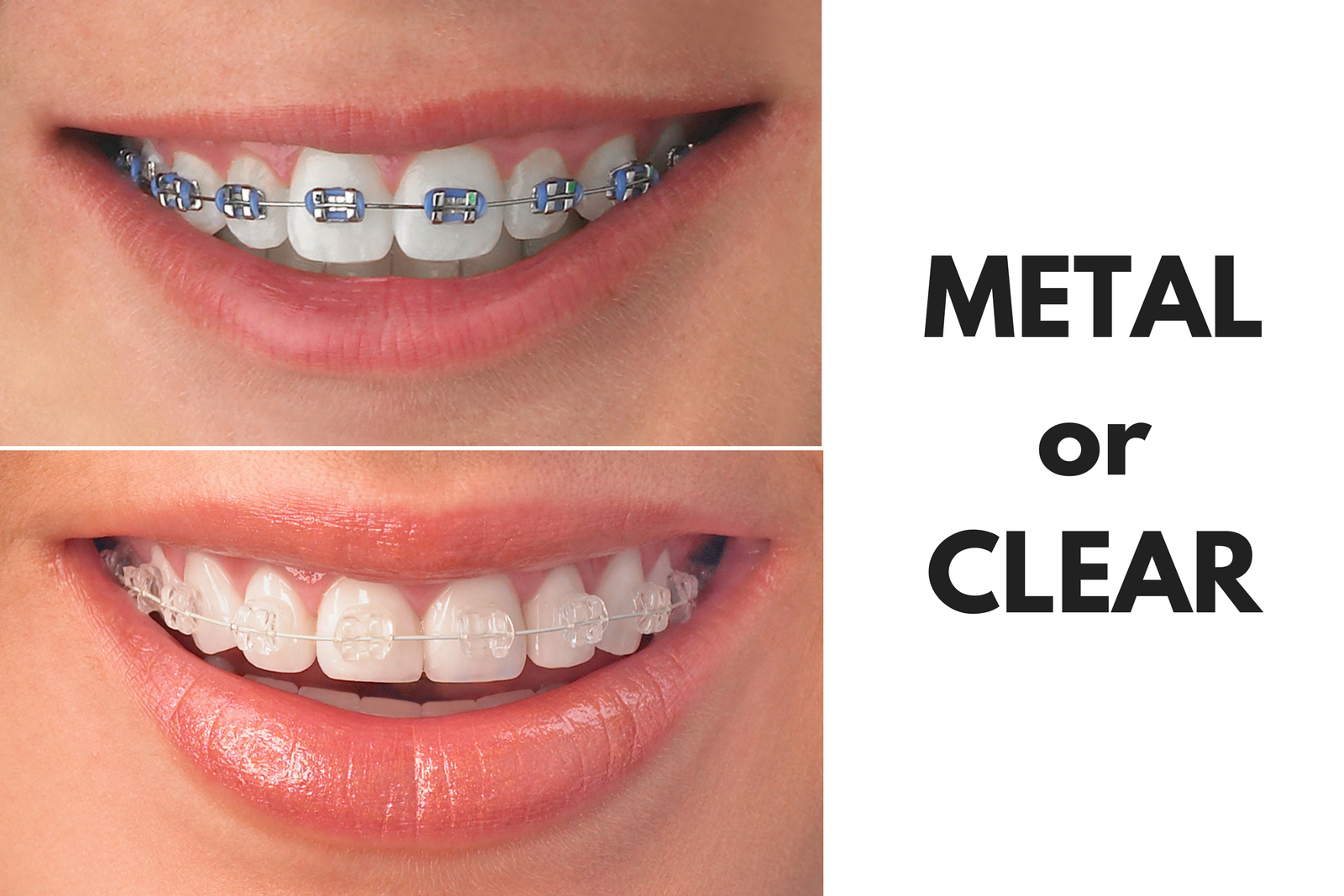 Ask Your Memphis Dentist: Should I Get Metal or Clear Braces?