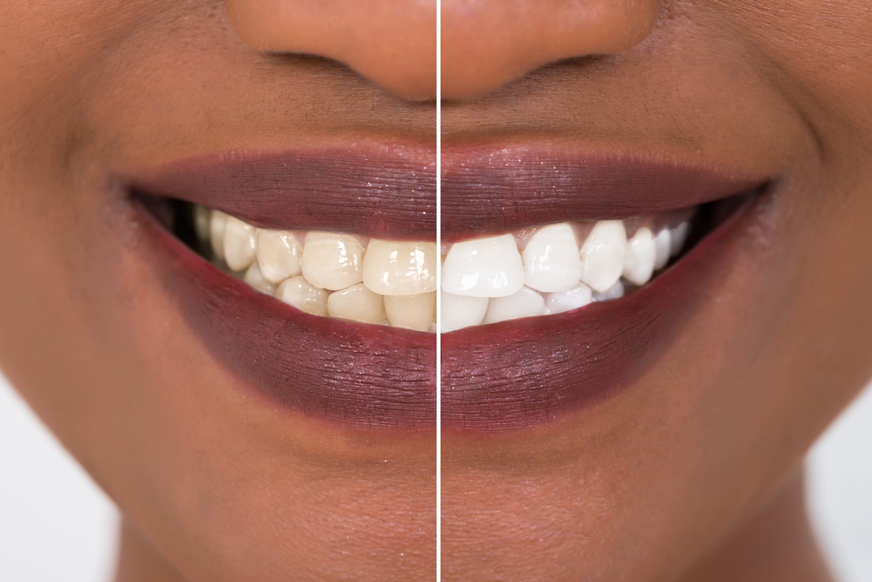 Before and after smile comparison showing teeth whitening results on woman's mouth.