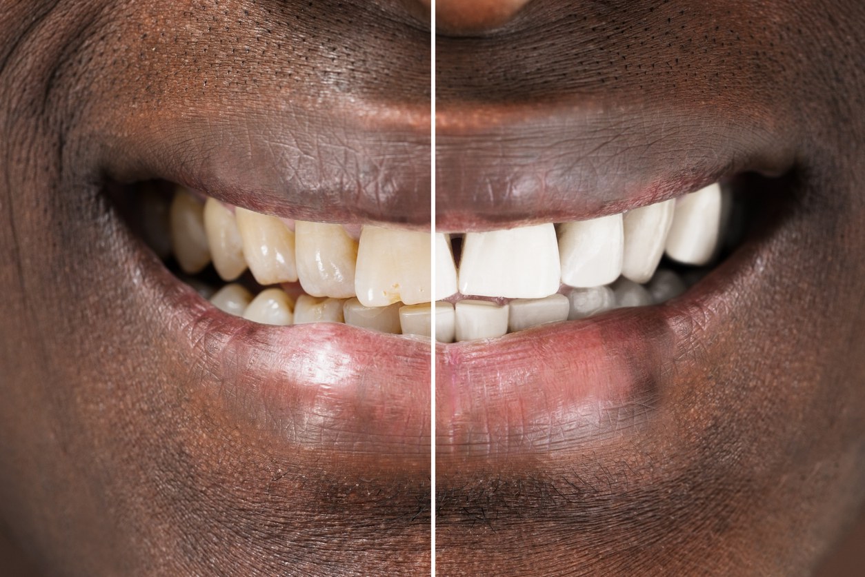 Before and after smile comparison showing teeth whitening results on dark skin tone.
