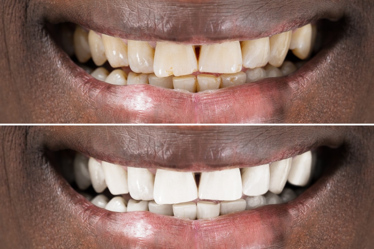Before and after dental treatment showing teeth whitening results on a smiling patient.