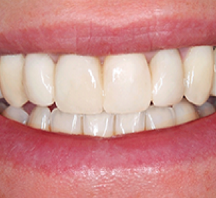 Close-up of healthy white teeth and pink gums in a bright smile.