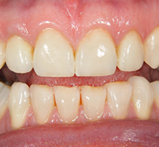 Close-up view of upper and lower teeth showing dental alignment and tooth coloration in mouth.
