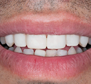 Close-up of a person's smile showing white, well-aligned teeth and healthy pink gums.