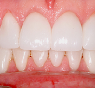 Close-up of healthy white upper and lower teeth with pink gums in dental setting.