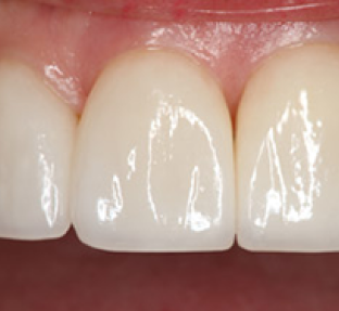 Close-up of three bright white front teeth showing dental work or whitening results.