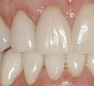 Close-up view of healthy, white upper teeth and gums in dental setting.