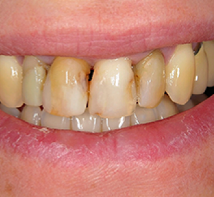 Close-up of discolored and stained teeth showing dental concerns requiring professional treatment.