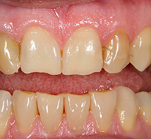 Close-up view of upper and lower teeth showing natural tooth color and gum health during dental examination.
