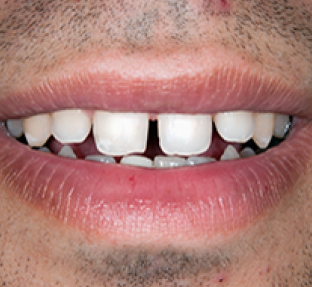 Close-up of smile showing gap between front teeth before dental treatment.