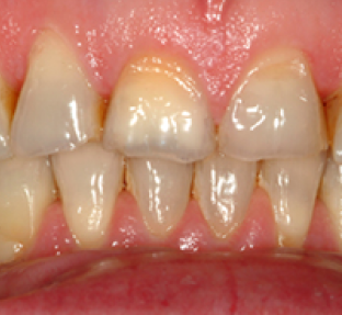 Close-up of upper front teeth showing dental work and gum tissue in clinical setting.