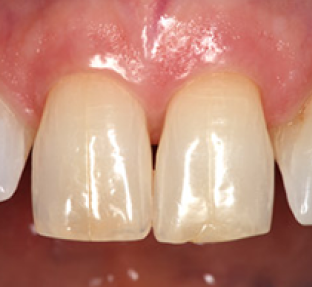 Two front teeth with natural crown restorations displayed in oral cavity during dental examination.