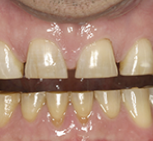 Close-up of dental crown procedure showing upper front teeth with temporary shade guide band during cosmetic dentistry consultation.