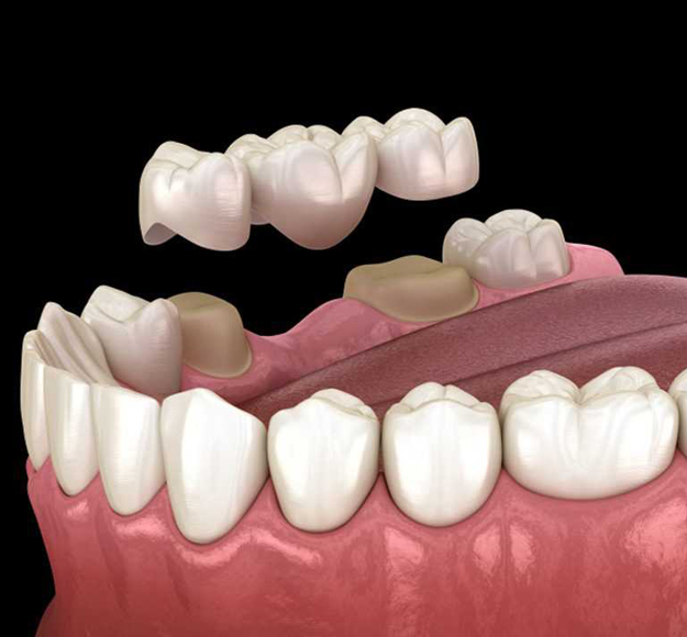 Dental bridge placement illustration showing tooth replacement on gum model with natural teeth.