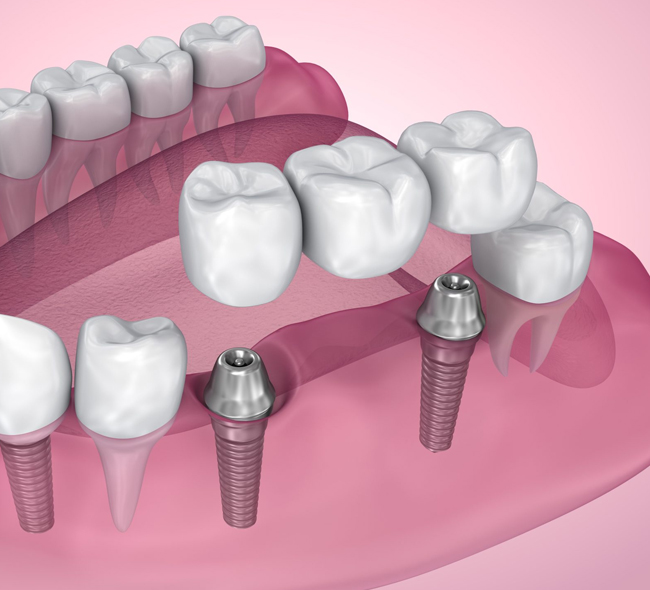 Dental implants illustration showing prosthetic teeth and implant fixtures on pink gum model.