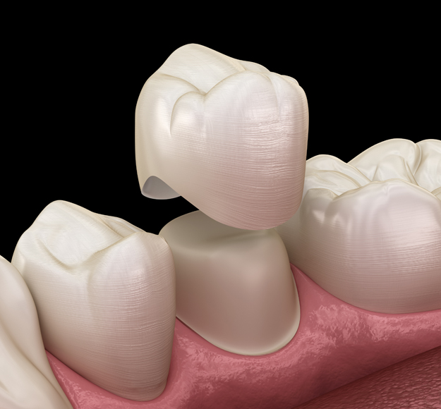 Dental crowns demonstration showing tooth-colored restorations on model gums for cosmetic dentistry.