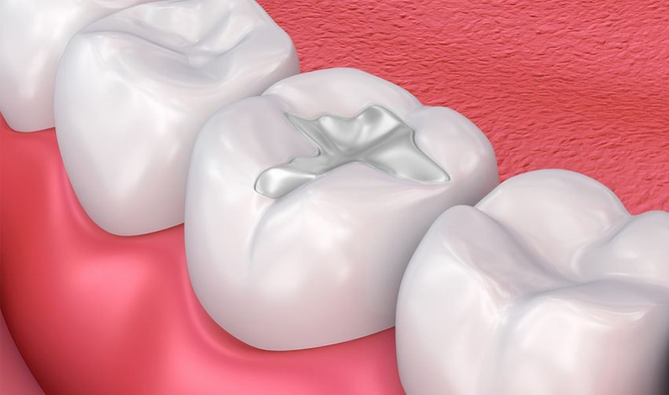 Three white dental crowns positioned on pink gum tissue model showing dental restoration procedure.
