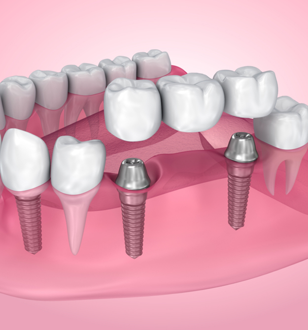 Dental implants illustration showing titanium posts and crowns in pink gum model.