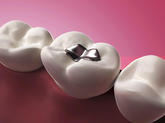 White teeth with cavity and dark decay against pink background, dental health concept.