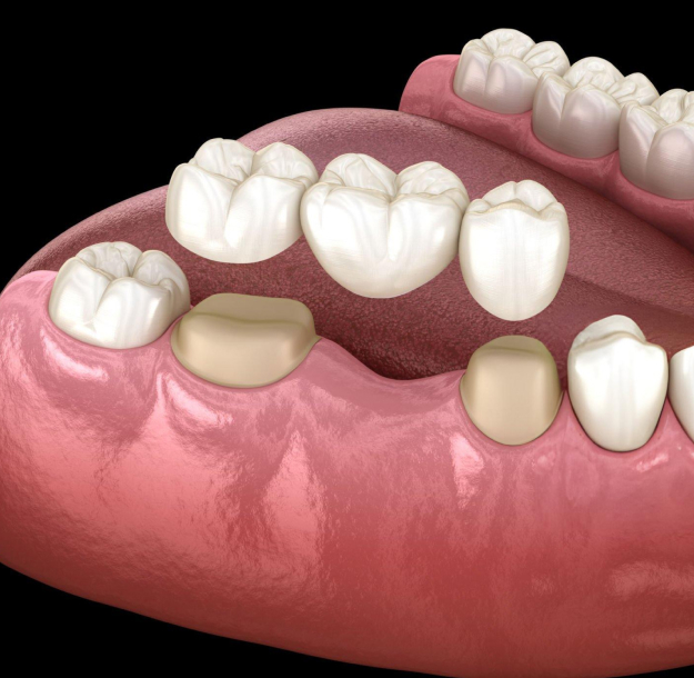 3D dental model showing tooth implant placement in jawbone with surrounding teeth and gum tissue.