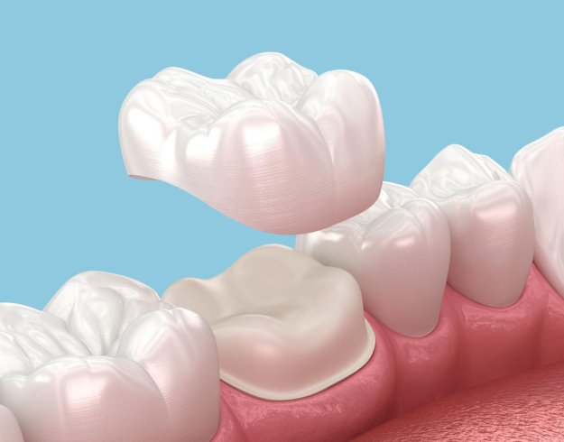 Dental crown being placed over tooth with gum tissue visible against blue background