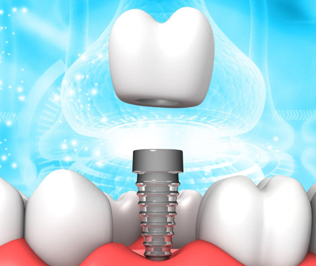 Dental implant illustration showing crown above titanium screw fixture surrounded by healthy teeth.