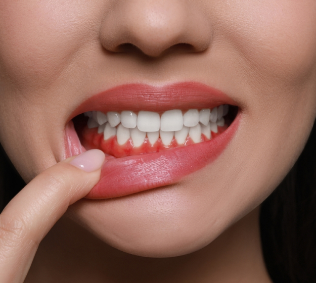 Close-up of person's smile showing white teeth and healthy gums with finger pointing to lip.