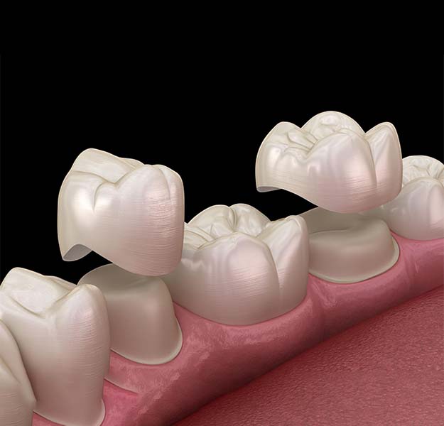 Dental crowns placed on tooth models demonstrating restorative dentistry procedure and tooth replacement.