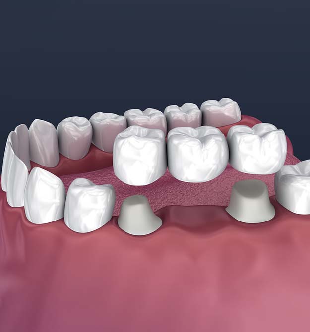 3D dental model showing tooth restoration with crowns and bridges on gum tissue.
