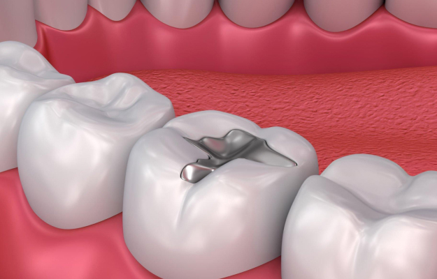 3D dental illustration showing tooth cavity treatment between molars in pink gum tissue.