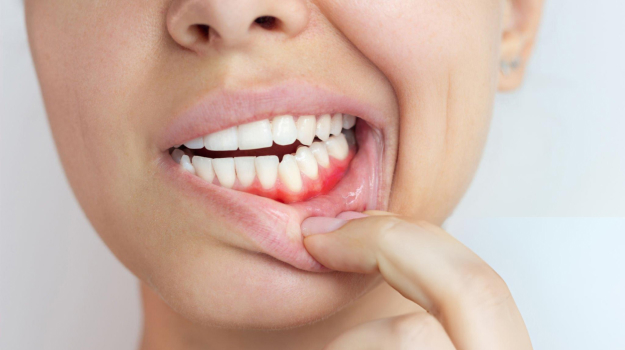 Person pointing to inflamed gum area showing signs of gum disease or irritation.