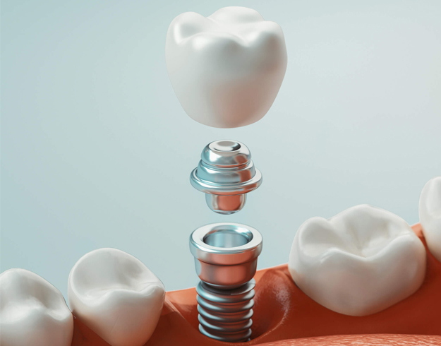 Dental implant components displayed with white cloud-shaped models on coral surface against light blue background.