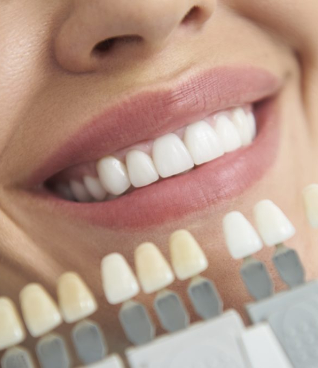 Close-up of smiling woman's teeth next to dental shade guide showing whiteness comparisons.