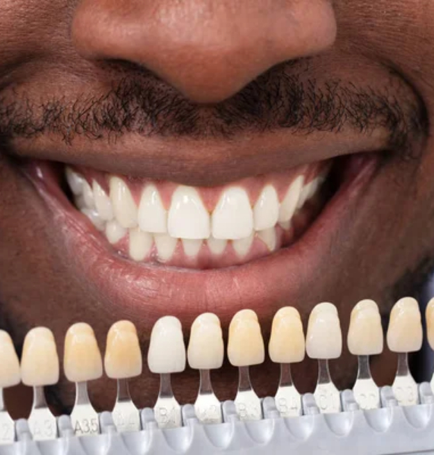 Man smiling displaying natural teeth next to shade guide showing tooth color options.