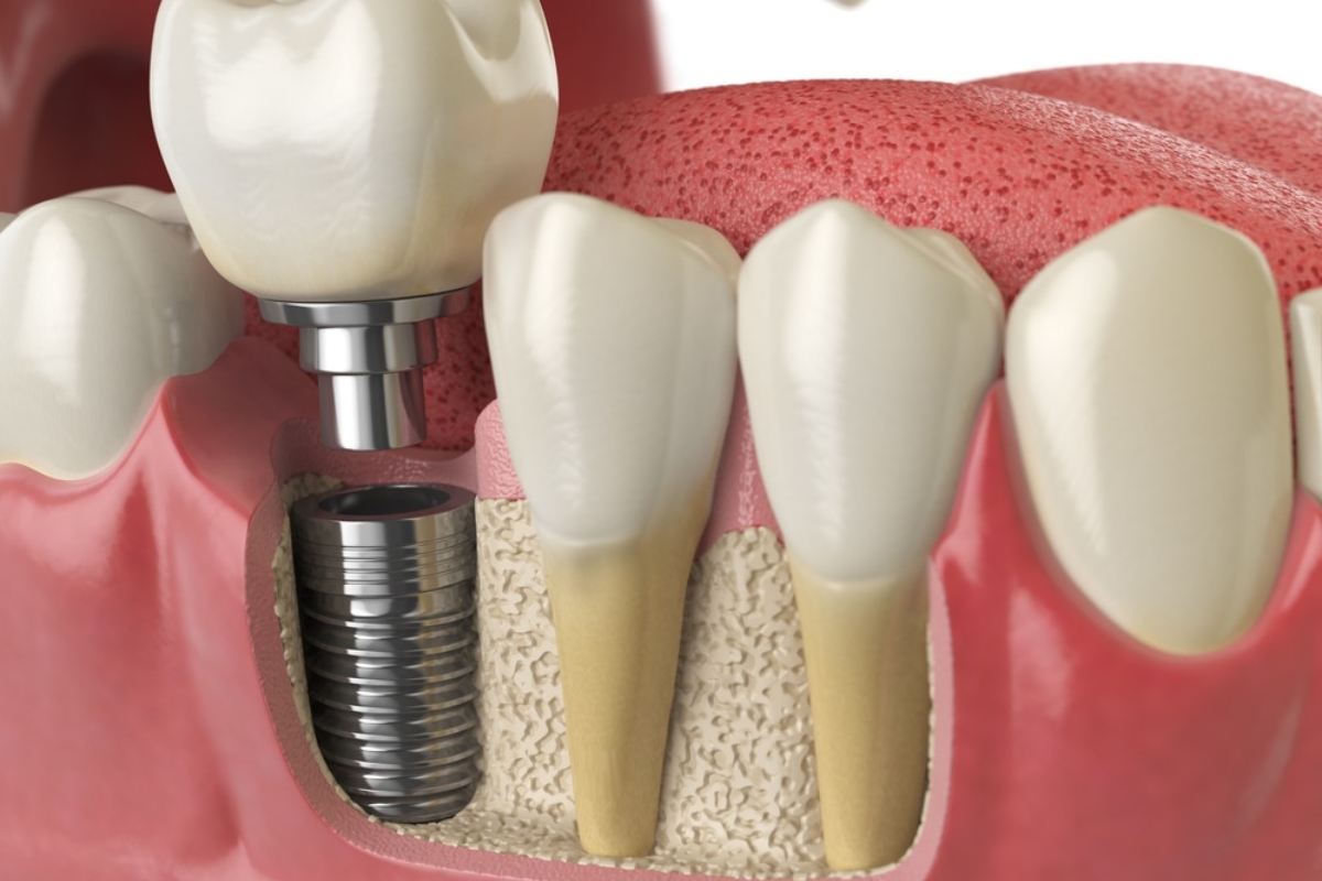 Dental Implants Jackson