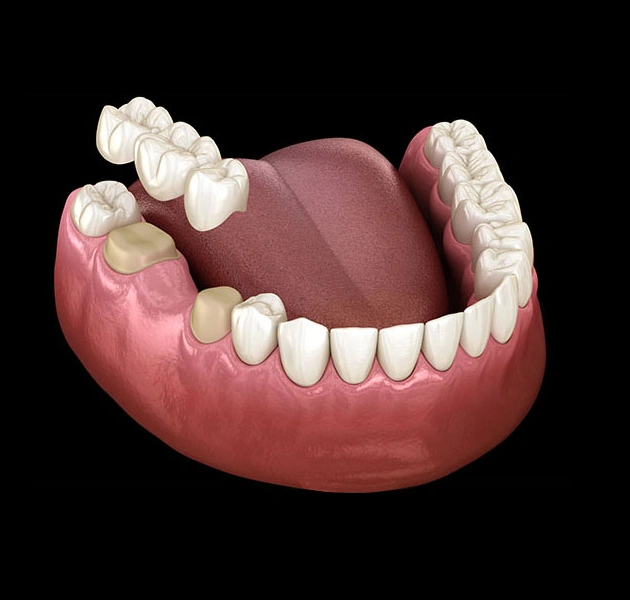 3D dental model showing complete denture with artificial teeth on pink gum base.