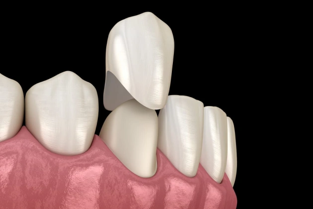 Digital illustration of dental crowns placed on model teeth with pink gum tissue.