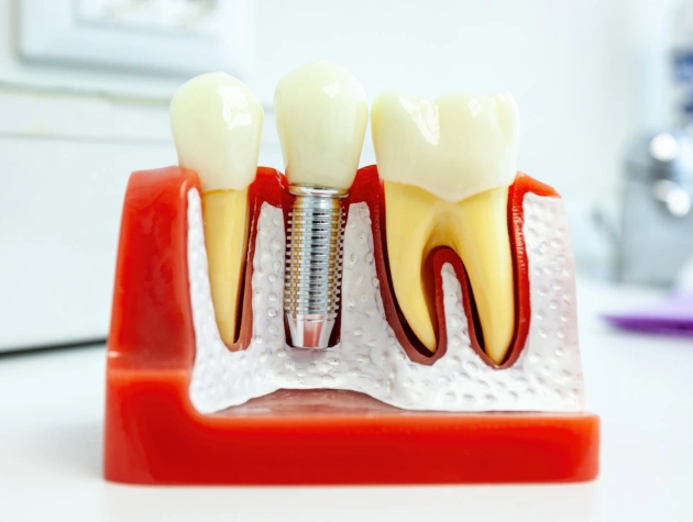 Dental implant model showing tooth structure, crown, and titanium screw on red base in clinical setting.