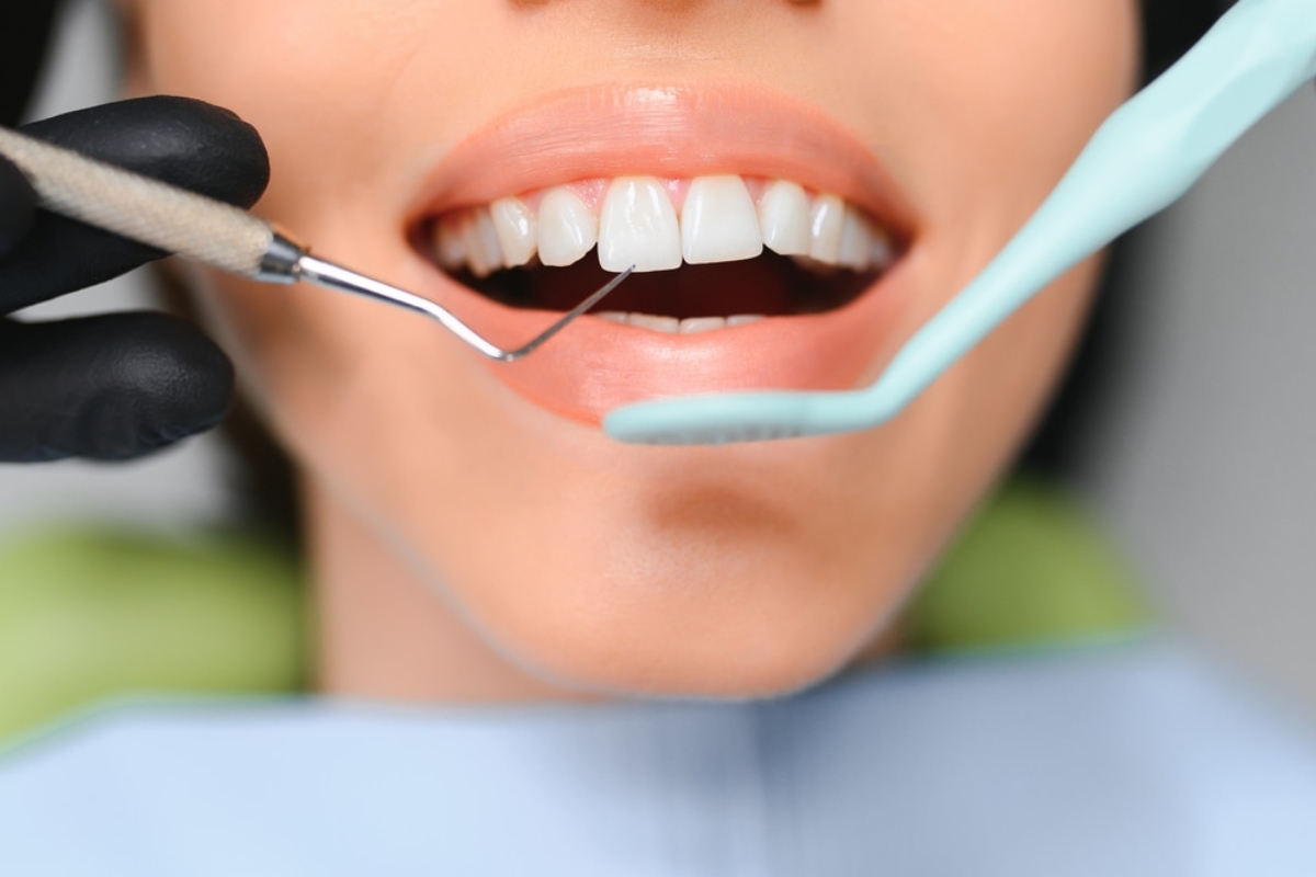 Teeth Whitening Jackson