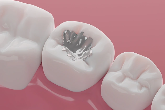Natural-Looking Composite Fillings for Stronger Teeth