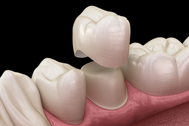 Reliable Dental Crowns for Stronger Teeth