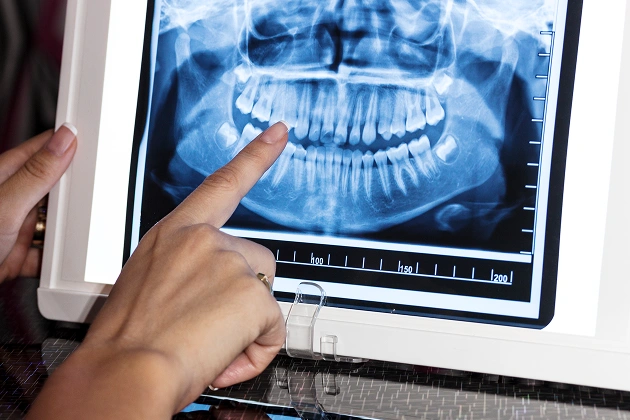 What Are Digital X-Rays
